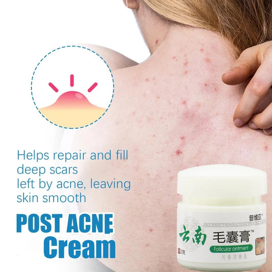 Body Acne Removal Cream | Post Acne Cream | Glamora
